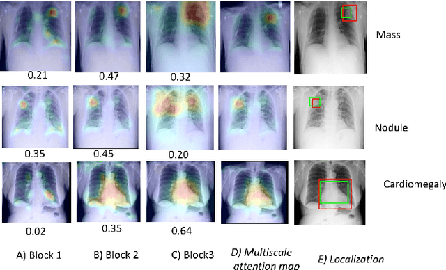 Figure 3 for Deep multiscale convolutional feature learning for weakly supervised localization of chest pathologies in X-ray images