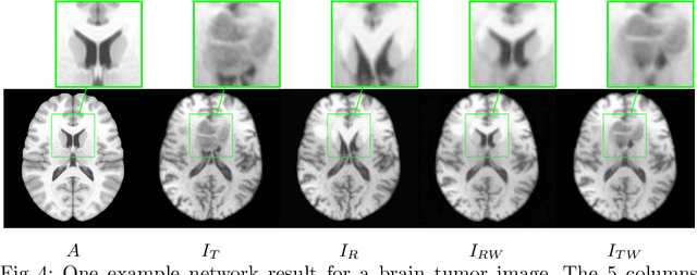 Figure 4 for A Deep Network for Joint Registration and Reconstruction of Images with Pathologies