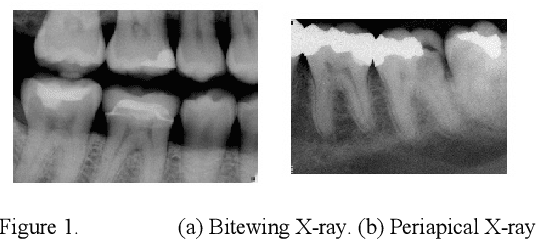 Figure 1 for Developing a Novel Approach for Periapical Dental Radiographs Segmentation