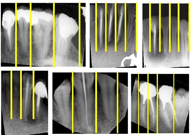 Figure 2 for Developing a Novel Approach for Periapical Dental Radiographs Segmentation