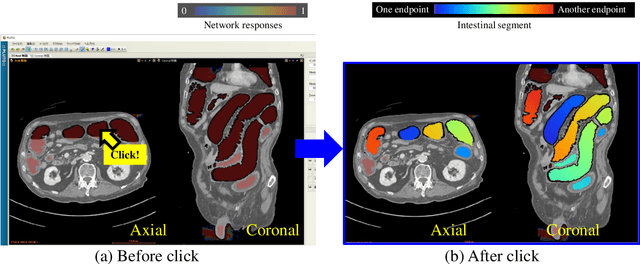 Figure 4 for Visualizing intestines for diagnostic assistance of ileus based on intestinal region segmentation from 3D CT images