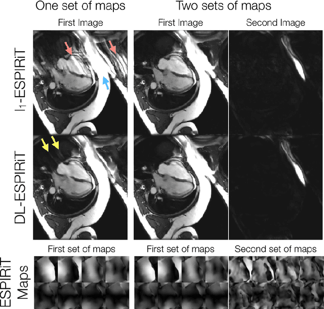 Figure 4 for Accelerating cardiac cine MRI beyond compressed sensing using DL-ESPIRiT