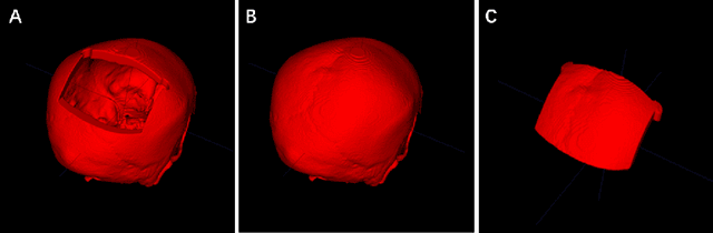 Figure 1 for A Baseline Approach for AutoImplant: the MICCAI 2020 Cranial Implant Design Challenge