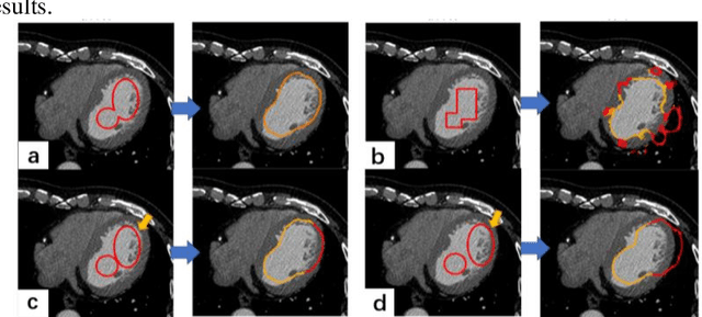 Figure 4 for Cardiac CT segmentation based on distance regularized level set