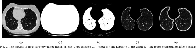 Figure 2 for Automatic Pulmonary Nodule Detection in CT Scans Using Convolutional Neural Networks Based on Maximum Intensity Projection
