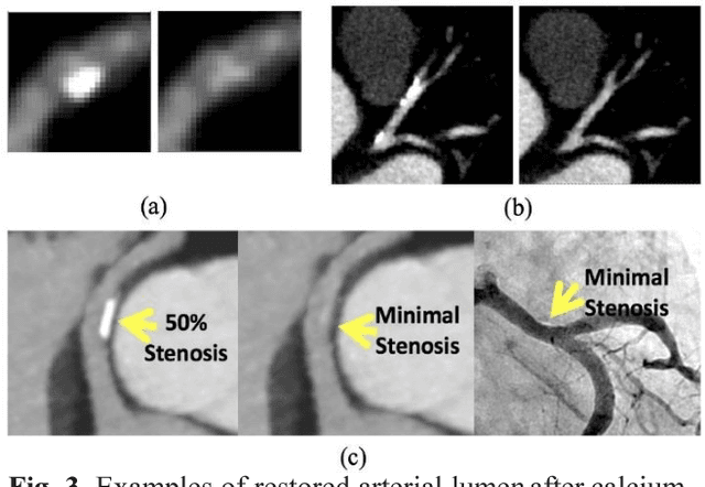 Figure 3 for Calcium Removal From Cardiac CT Images Using Deep Convolutional Neural Network