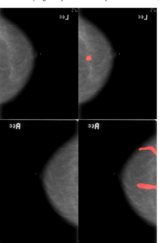 Figure 1 for Deep learning approach for breast cancer diagnosis