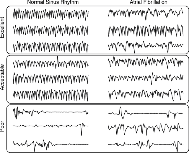 Figure 1 for DeepBeat: A multi-task deep learning approach to assess signal quality and arrhythmia detection in wearable devices