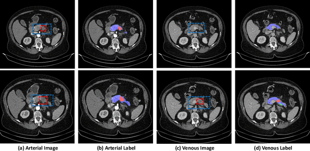 Figure 1 for Detecting Pancreatic Adenocarcinoma in Multi-phase CT Scans via Alignment Ensemble