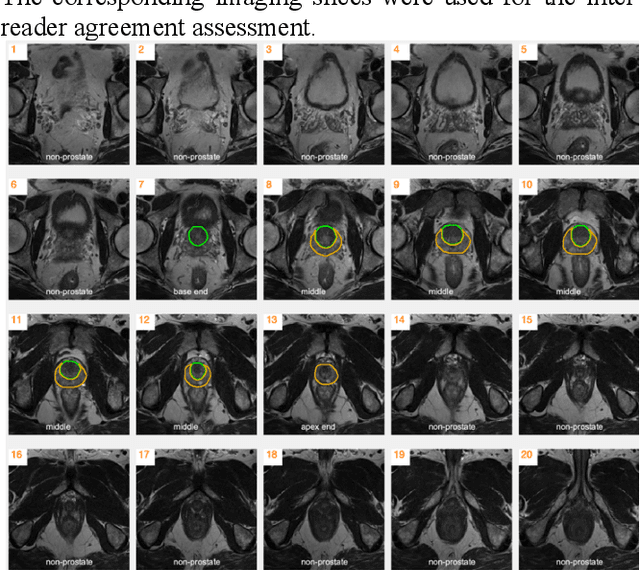 Figure 3 for Automatic Prostate Zonal Segmentation Using Fully Convolutional Network with Feature Pyramid Attention