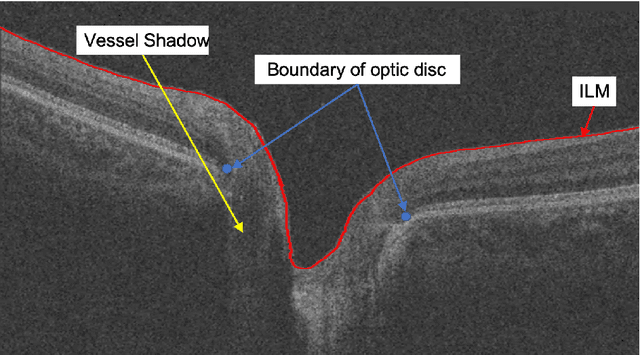 Figure 1 for The Channel Attention based Context Encoder Network for Inner Limiting Membrane Detection