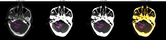 Figure 1 for Voxels Intersecting along Orthogonal Levels Attention U-Net (viola-Unet) to Segment Intracerebral Haemorrhage Using Computed Tomography Head Scans
