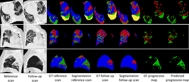 Figure 4 for Longitudinal Quantitative Assessment of COVID-19 Infection Progression from Chest CTs