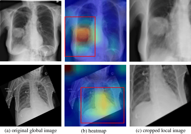 Figure 1 for Diagnose like a Radiologist: Attention Guided Convolutional Neural Network for Thorax Disease Classification