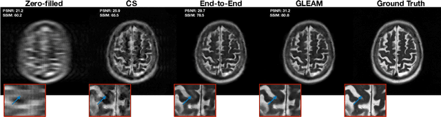 Figure 4 for GLEAM: Greedy Learning for Large-Scale Accelerated MRI Reconstruction
