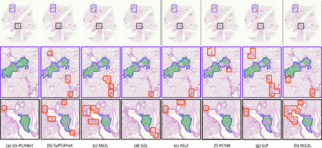 Figure 3 for Lung Cancer Lesion Detection in Histopathology Images Using Graph-Based Sparse PCA Network