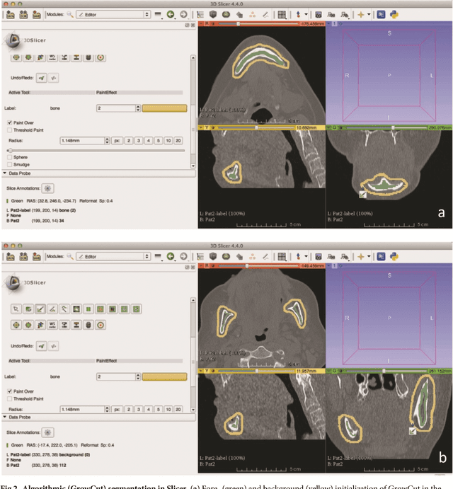 Figure 3 for Clinical evaluation of semi-automatic opensource algorithmic software segmentation of the mandibular bone: Practical feasibility and assessment of a new course of action