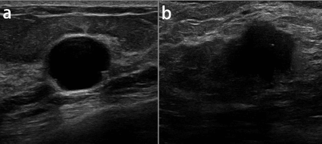 Figure 2 for Classification of Breast Cancer Lesions in Ultrasound Images by using Attention Layer and loss Ensembles in Deep Convolutional Neural Networks