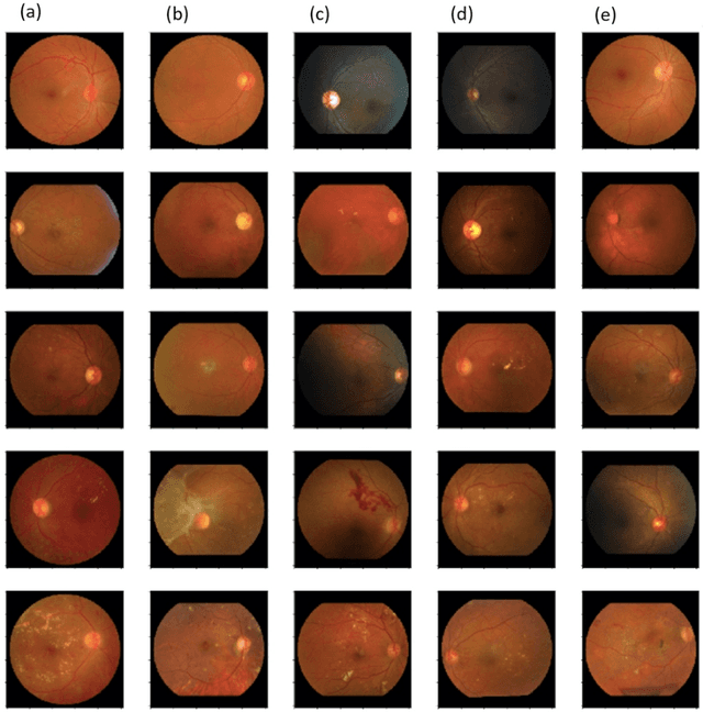 Figure 3 for Automated Diabetic Retinopathy Grading using Deep Convolutional Neural Network