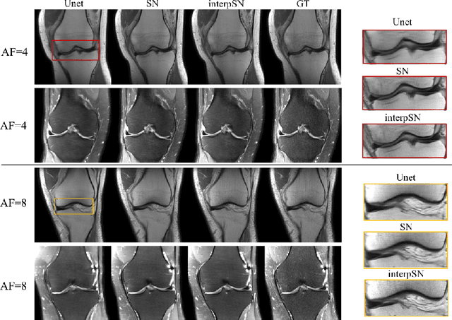 Figure 3 for Deep Network Interpolation for Accelerated Parallel MR Image Reconstruction