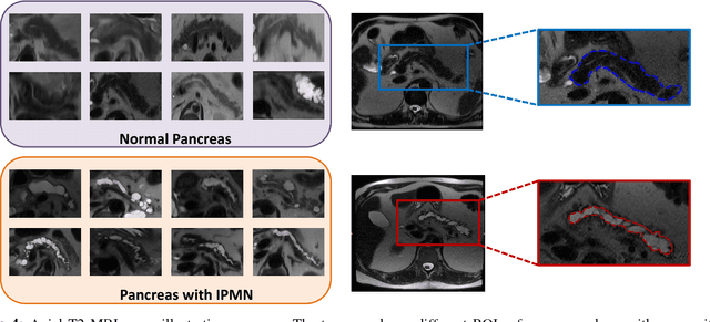Figure 4 for Supervised and Unsupervised Tumor Characterization in the Deep Learning Era