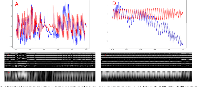 Figure 2 for Method to Annotate Arrhythmias by Deep Network