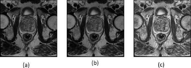 Figure 3 for An Enhanced Deep Learning Technique for Prostate Cancer Identification Based on MRI Scans