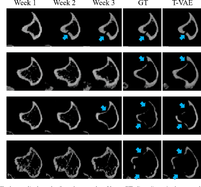 Figure 1 for Breast Cancer Induced Bone Osteolysis Prediction Using Temporal Variational Auto-Encoders