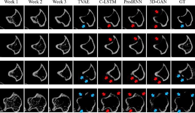 Figure 3 for Breast Cancer Induced Bone Osteolysis Prediction Using Temporal Variational Auto-Encoders