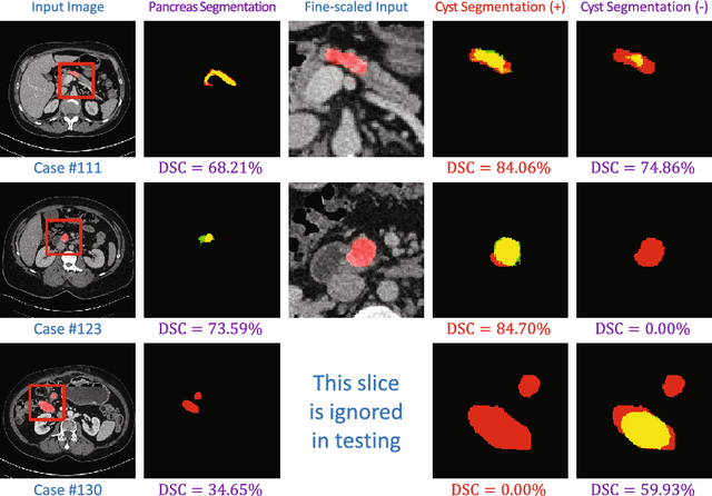 Figure 4 for Deep Supervision for Pancreatic Cyst Segmentation in Abdominal CT Scans