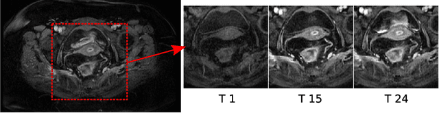 Figure 1 for Pieces-of-parts for supervoxel segmentation with global context: Application to DCE-MRI tumour delineation