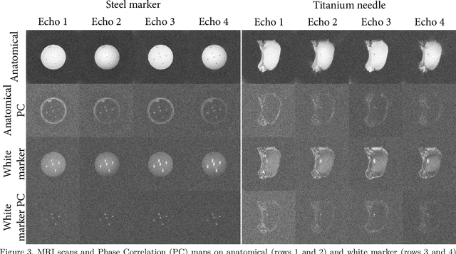 Figure 3 for SMART tracking: Simultaneous anatomical imaging and real-time passive device tracking for MR-guided interventions
