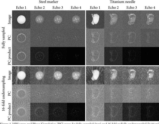 Figure 4 for SMART tracking: Simultaneous anatomical imaging and real-time passive device tracking for MR-guided interventions