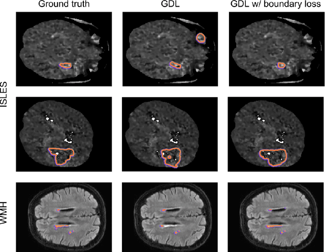 Figure 4 for Boundary loss for highly unbalanced segmentation