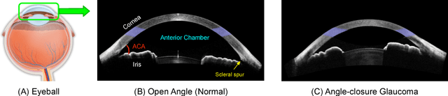Figure 1 for Multi-Context Deep Network for Angle-Closure Glaucoma Screening in Anterior Segment OCT