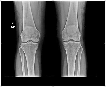 Figure 1 for Automatic Grading of Knee Osteoarthritis on the Kellgren-Lawrence Scale from Radiographs Using Convolutional Neural Networks