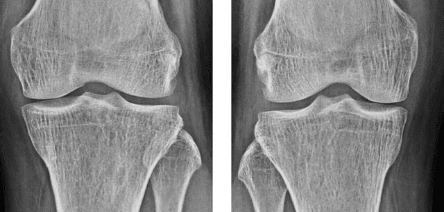 Figure 3 for Automatic Grading of Knee Osteoarthritis on the Kellgren-Lawrence Scale from Radiographs Using Convolutional Neural Networks