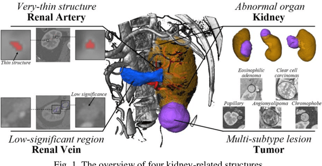 Figure 1 for Using Large Context for Kidney Multi-Structure Segmentation from CTA Images