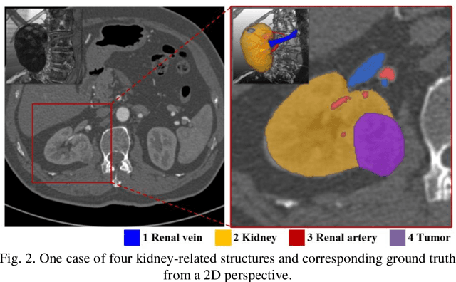 Figure 2 for Using Large Context for Kidney Multi-Structure Segmentation from CTA Images