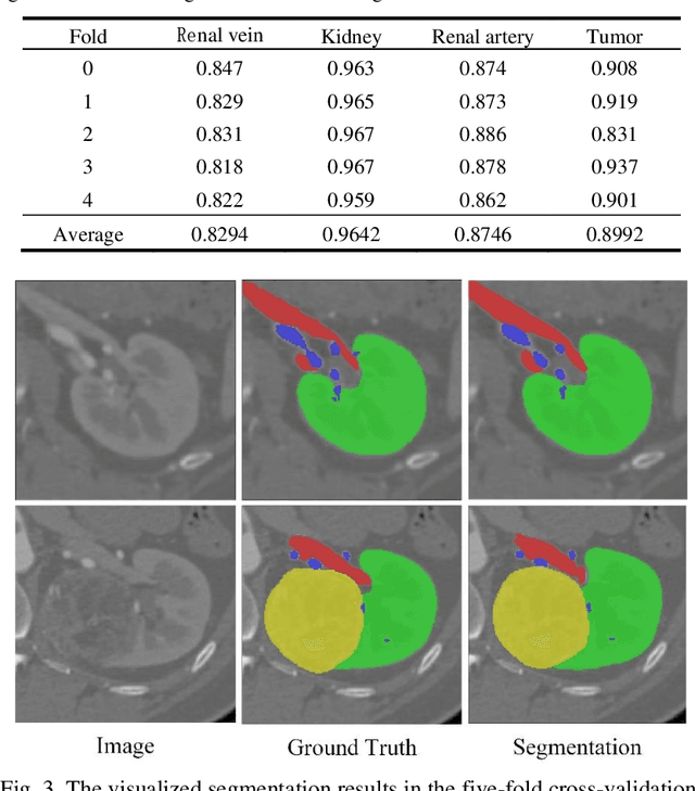 Figure 3 for Using Large Context for Kidney Multi-Structure Segmentation from CTA Images