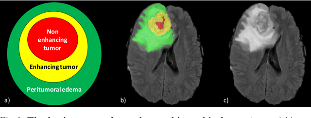 Figure 3 for Generalized Wasserstein Dice Score, Distributionally Robust Deep Learning, and Ranger for brain tumor segmentation: BraTS 2020 challenge