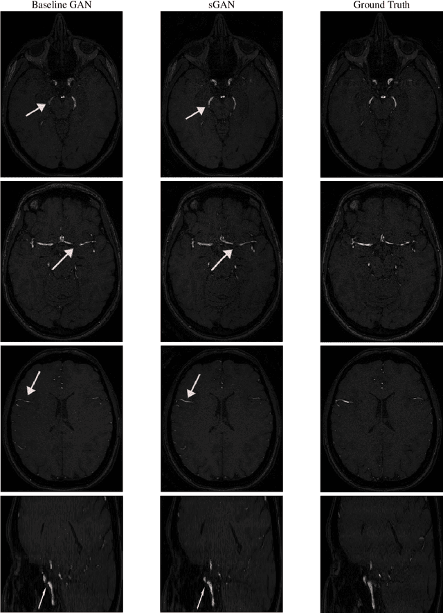 Figure 4 for Generative Adversarial Training for MRA Image Synthesis Using Multi-Contrast MRI