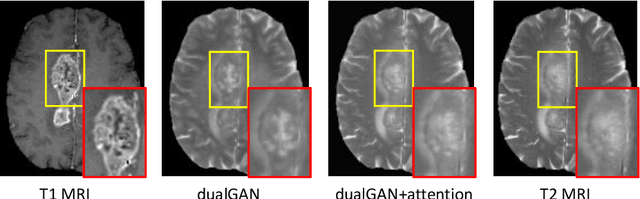 Figure 4 for Dual Adversarial Learning with Attention Mechanism for Fine-grained Medical Image Synthesis