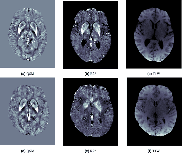 Figure 1 for Q-Net: A Quantitative Susceptibility Mapping-based Deep Neural Network for Differential Diagnosis of Brain Iron Deposition in Hemochromatosis