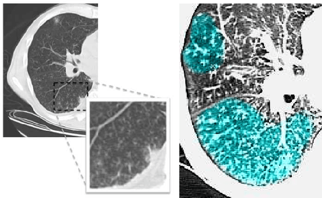 Figure 1 for Learning Shape and Texture Characteristics of CT Tree-in-Bud Opacities for CAD Systems