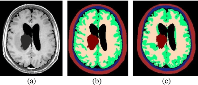 Figure 1 for Evaluation of head segmentation quality for treatment planning of tumor treating fields in brain tumors