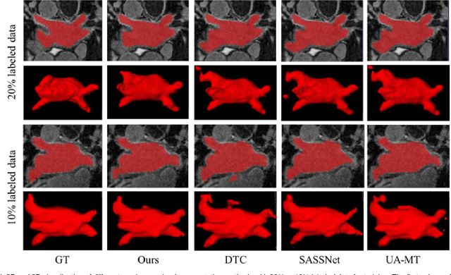 Figure 4 for Semi-supervised Medical Image Segmentation via Geometry-aware Consistency Training