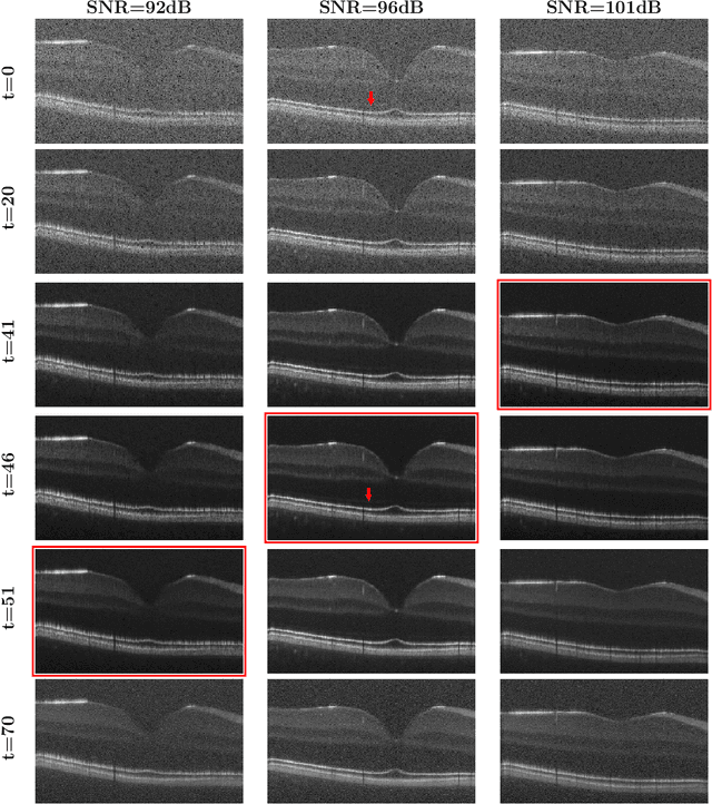 Figure 3 for Unsupervised Denoising of Retinal OCT with Diffusion Probabilistic Model