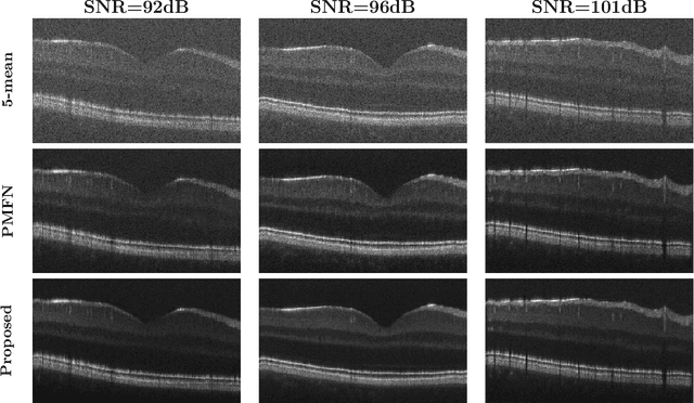 Figure 4 for Unsupervised Denoising of Retinal OCT with Diffusion Probabilistic Model