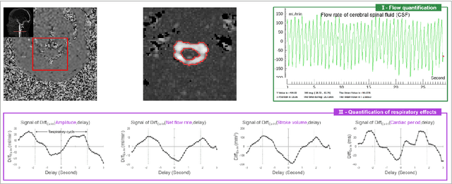 Figure 4 for Flow 2.0 -a flexible, scalable, cross-platform post-processing software for realtime phase contrast sequences